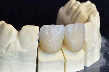dental crowns in Regulus