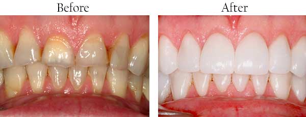Regulus Before and After Invisalign