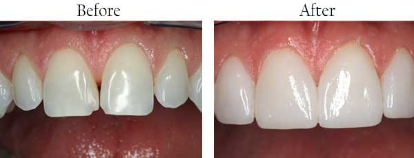 Regulus Before and After Teeth Whitening