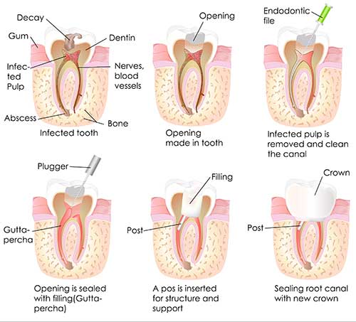 Regulus Root Canal