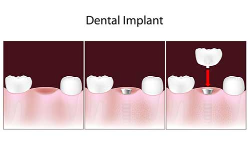 Implant Dentist in Regulus