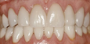 Regulus Before and After Teeth Whitening