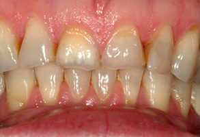 Before and After Invisalign Regulus