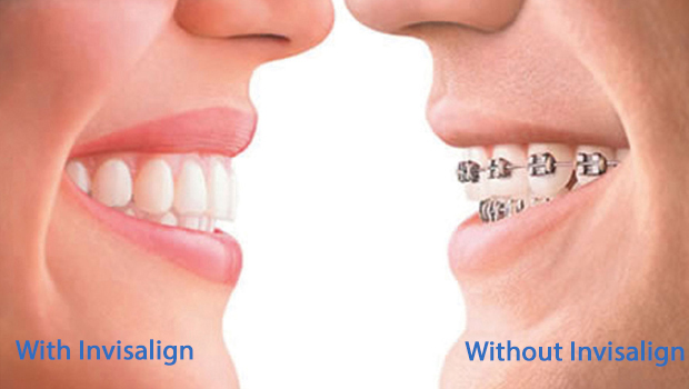 With and Without Invisalign