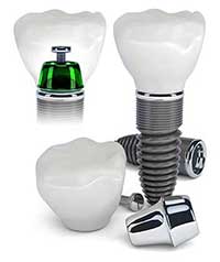 Dental Implants in Regulus