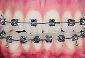 Regulus Before and After Dental Braces