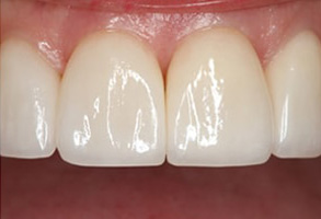 Regulus Before and After Amalgam Fillings