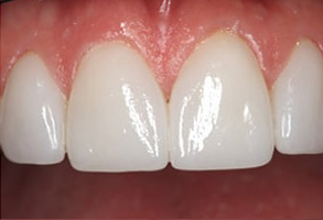 Regulus Before and After Root Canal Therapy