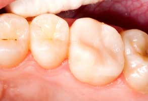 Regulus Before and After Dental Bridges