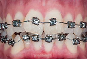 Regulus Before and After Braces