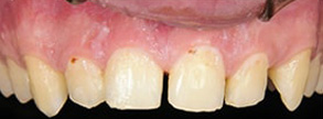 Regulus Before and After Dental Implants