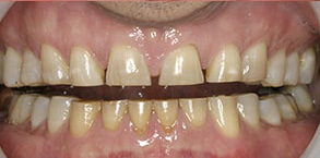 Regulus Before and After Composite Fillings