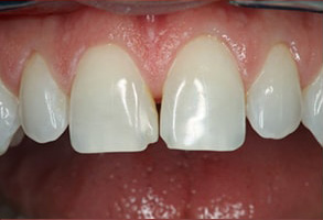 Regulus Before and After Root Canals