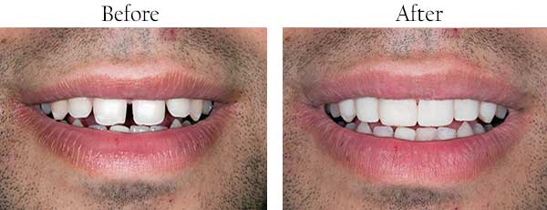 Regulus Before and After Dental Implants