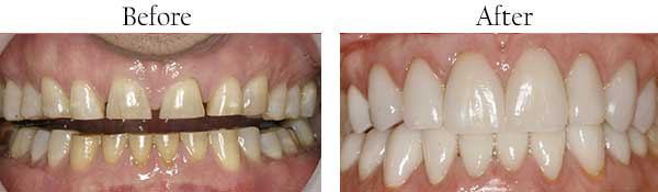 Regulus Before and After Invisalign